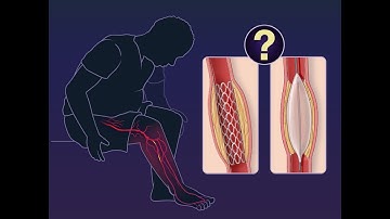 Drug-Eluting Scaffold for Infrapopliteal Disease | NEJM