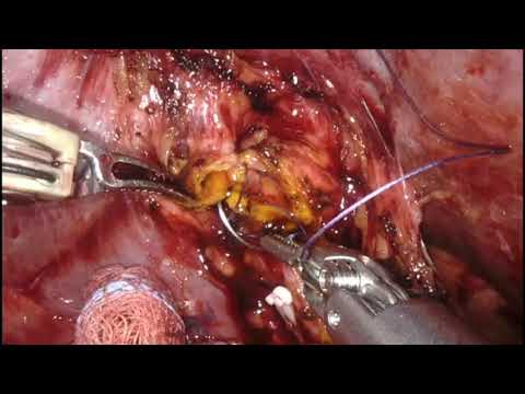 Robotic hepaticojejunostomy for stenosis hepatic duct (Strasberg E3)