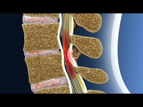 5.  Как болит стеноз позвоночного канала