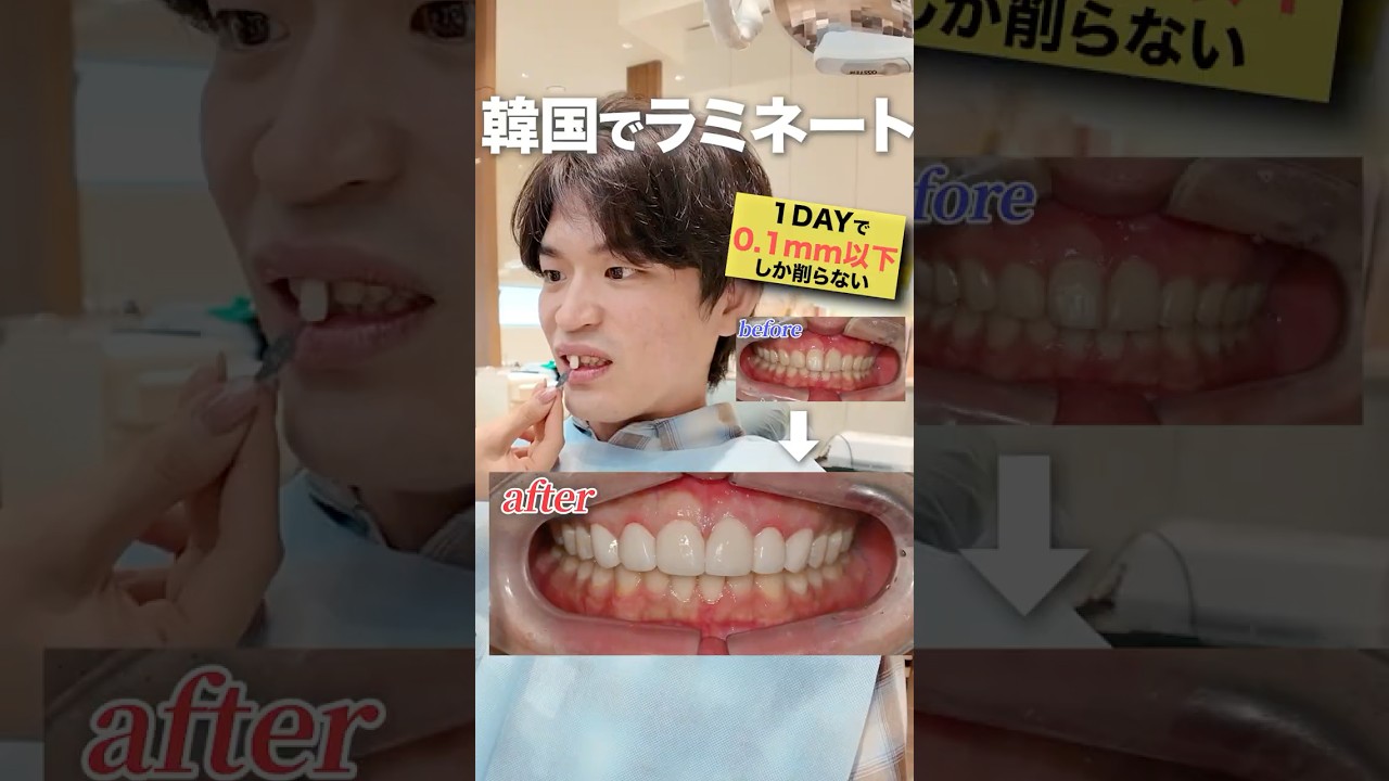 韓国の歯のラミネート技術がすごいと噂を聞いて行ってきた🦷