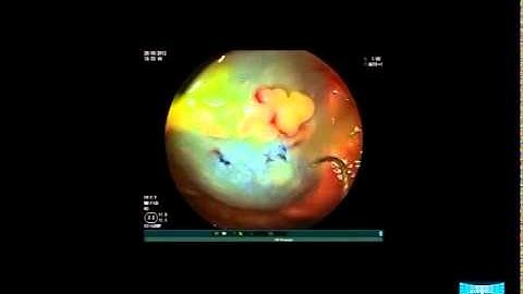 Sessile Serrated Colorectal Lesions: Endoscopic Features and Resection