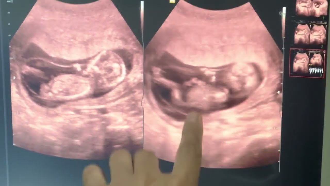 យល់ដឹងពីសរសៃរឆ្មារស្រោមទឹកភ្លោះ រុំ ទៅលើអវៈយវៈនិងរាងកាយ Amniotic Band Syndrom អេកូណុបសុដេត 092913793