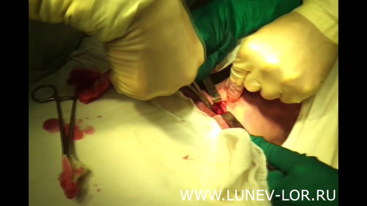 Трахеостомия #1