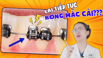 Bung Mắc Cài: 6 Nguyên Nhân Gây Bung Mắc Cài Niềng Răng Không Thể Ngờ Tới (100% Bạn Không Biết)