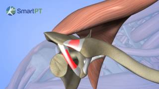Shoulderacromio Clavicular Sprain Type 1