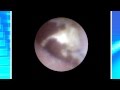 Ear endoscope ear wax イヤースコープ windows 内視鏡付 パソコン PC 耳かき 約15倍拡大