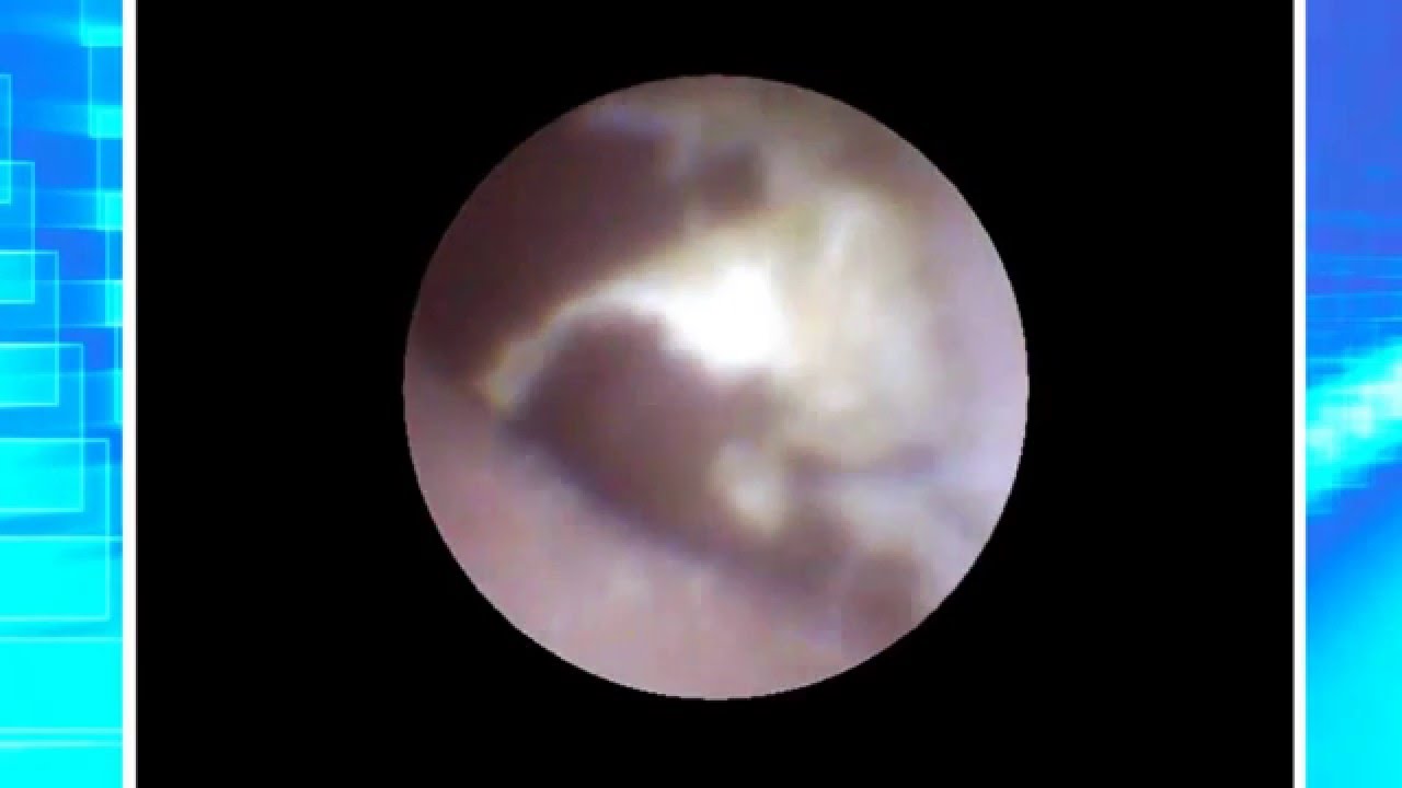 Ear Endoscope Ear Wax イヤースコープ Windows 内視鏡付 パソコン Pc 耳かき 約15倍拡大 Youtube