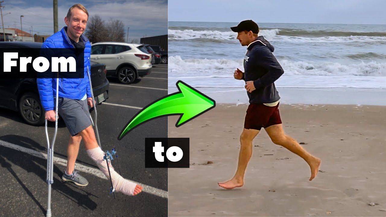 Tib/Fib Fracture Recovery: 3-Year Update - YouTube