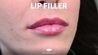 Filler Labbra Acido Ialuronico Dr Lipbeauty