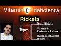 Vitamin-D deficiency : Rickets and types of rickets (Renal,Vitamin D resistance & Hypophospatemic)