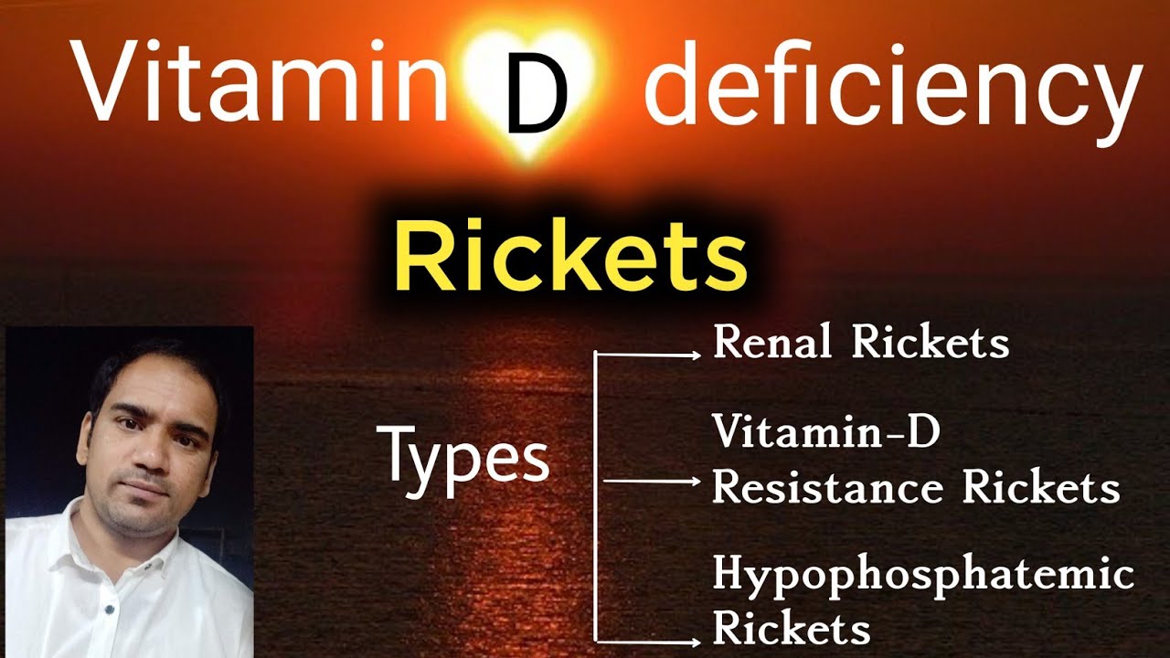 vitamin-d-deficiency-rickets-and-types-of-rickets-renal-vitamin-d