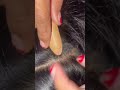 #fypviralシ #statisfying #lice #hair #LiceOnHead #liceremoval  #brasil #xyzbcafyp #licecomb  #kutu