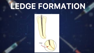 LEDGE FORMATION