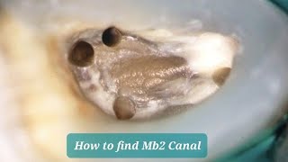 Upper 6 Access Cavity - How to Find MB2 Canal