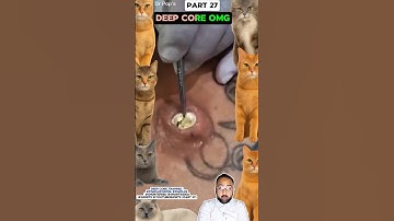 Deep Core Trapped #pimplepopper #pimples #shortsfeed #shortvideo #skincare #educational #shorts