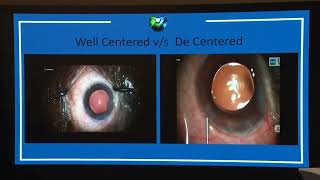 Information AIOC2026 IC115 Phaco Surgery Small Things Make Big Difference Dr Vinod Mehta Guide