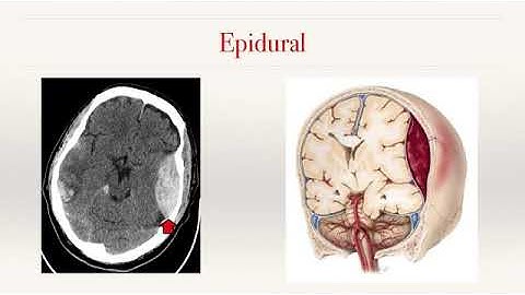 Overview: RSNA Intracranial haemorrhage detection
