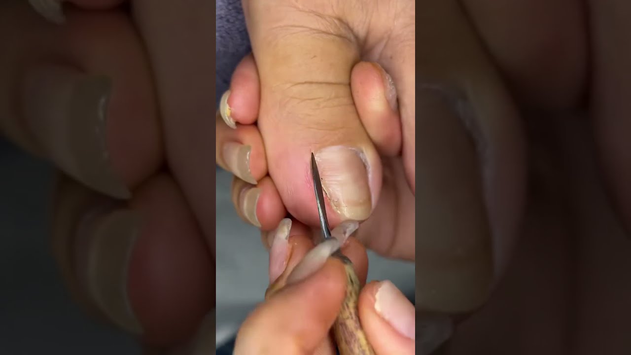 Toenail Transformation Cut Clean And Shine Nails