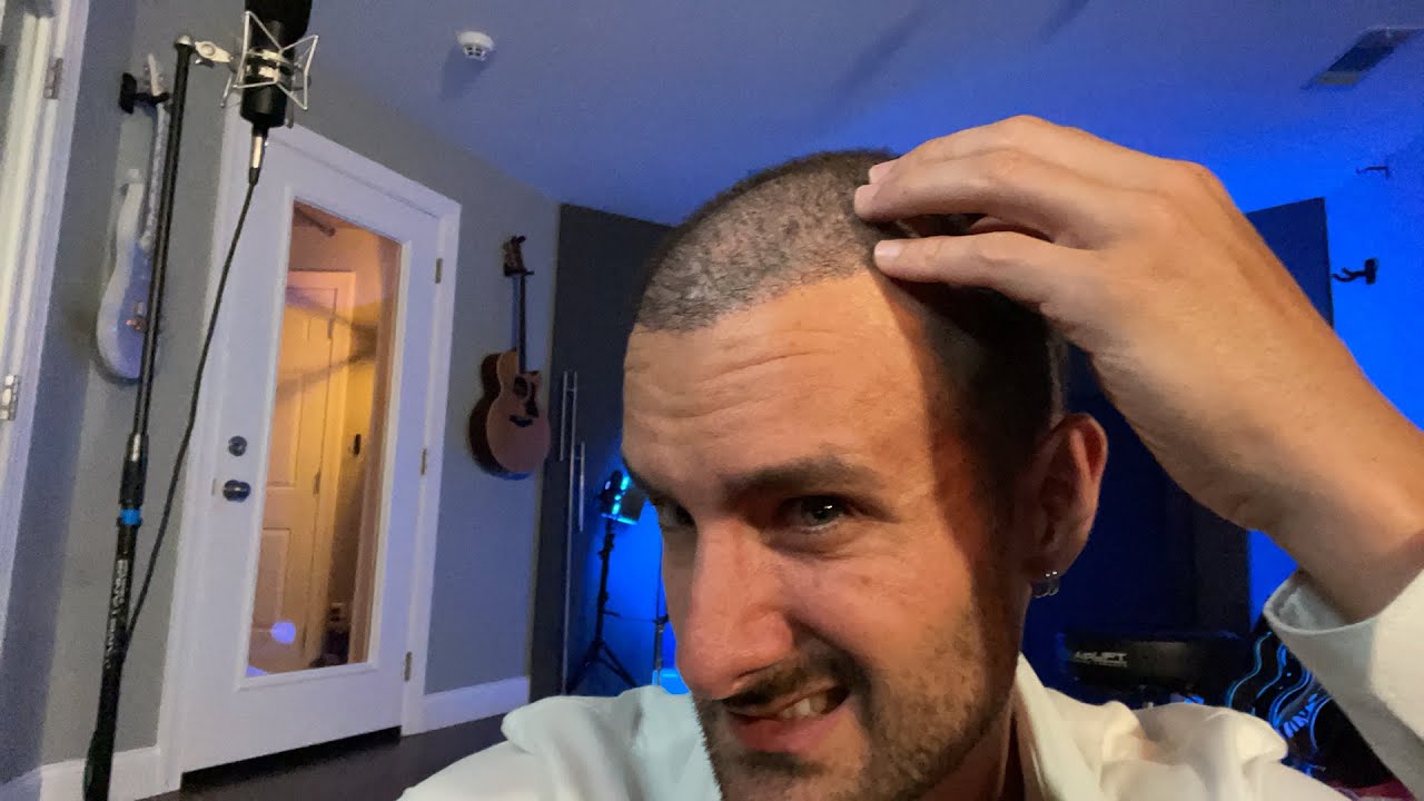 Bad Hair Day? - Day 14 Post Op