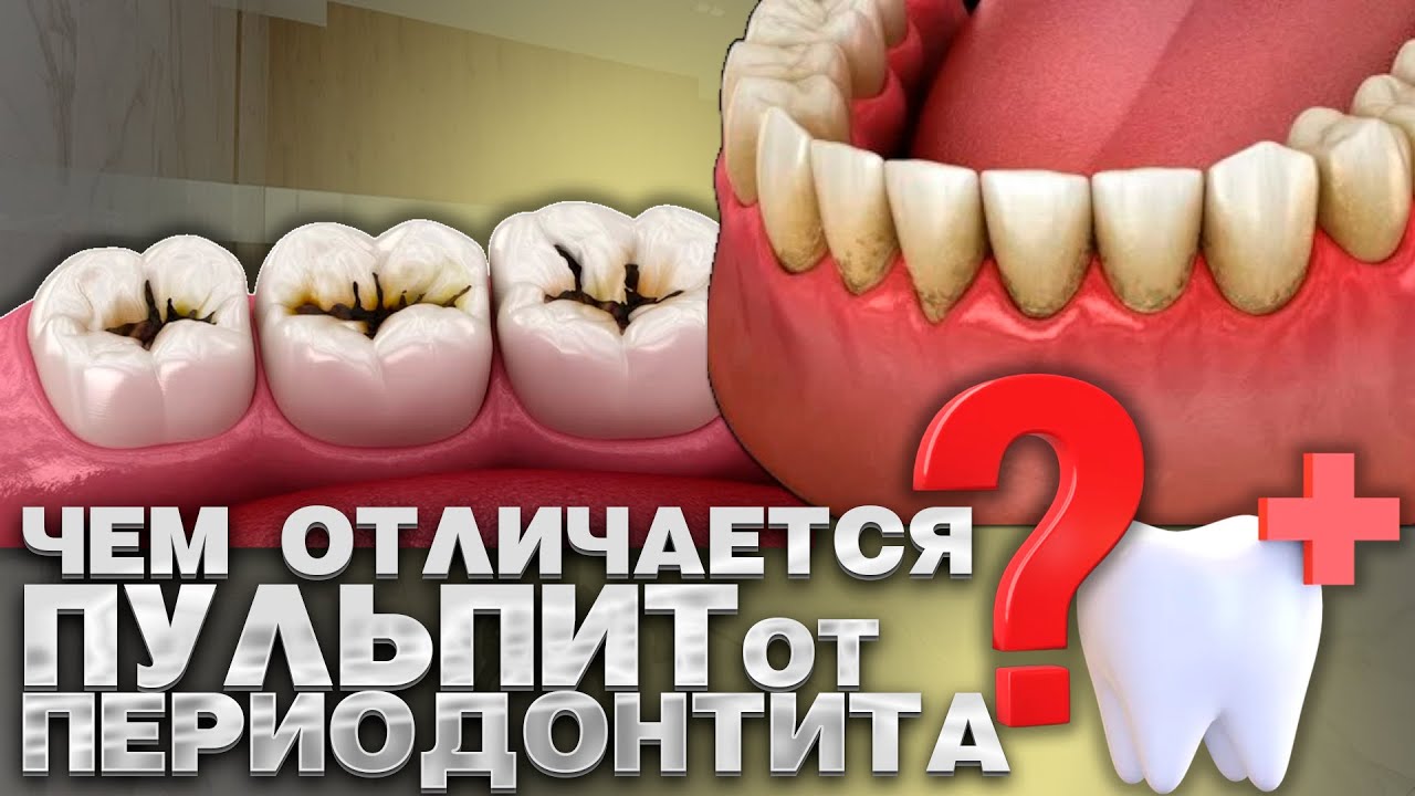 Чем отличается пульпит от периодонтита?