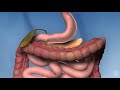 Sleeve gastrectomy