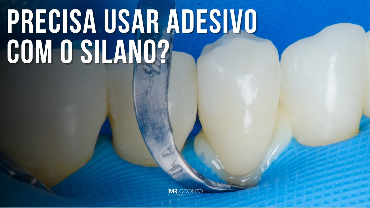 PRECISA USAR ADESIVO COM O SILANO NAS SUAS CIMENTAÇÕES ADESIVAS?
