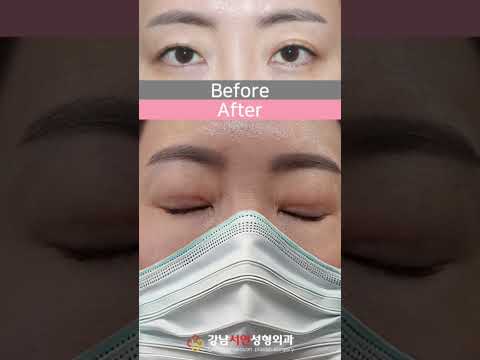 🌟 강남서연 상안검 후 1년 6개월🌟 💌관심 있으신 분들은 카카오 플러스 톡으로 강남서연성형외과에 문의주시면 됩니다!💌#강남서연 #ㄱㄴㅅㅇ #쌍꺼풀 #쌍수 #상안검 #눈꺼풀처짐