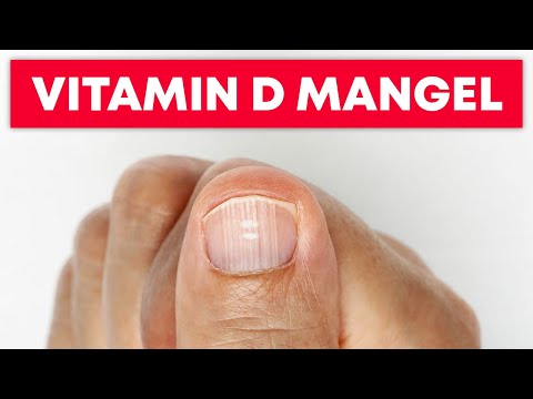 Video: Avitaminose - Vitaminmangel Auf Der Haut, Symptome Und Vorbeugung