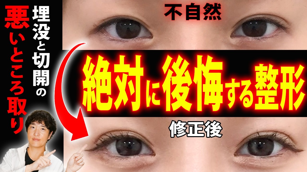 WARNING] For those considering double eyelid surgery using the