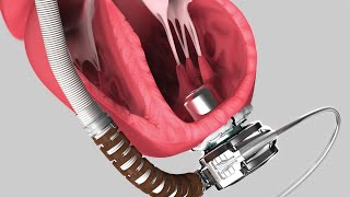 Medical Device Animation: Heartware System LVAD Pump