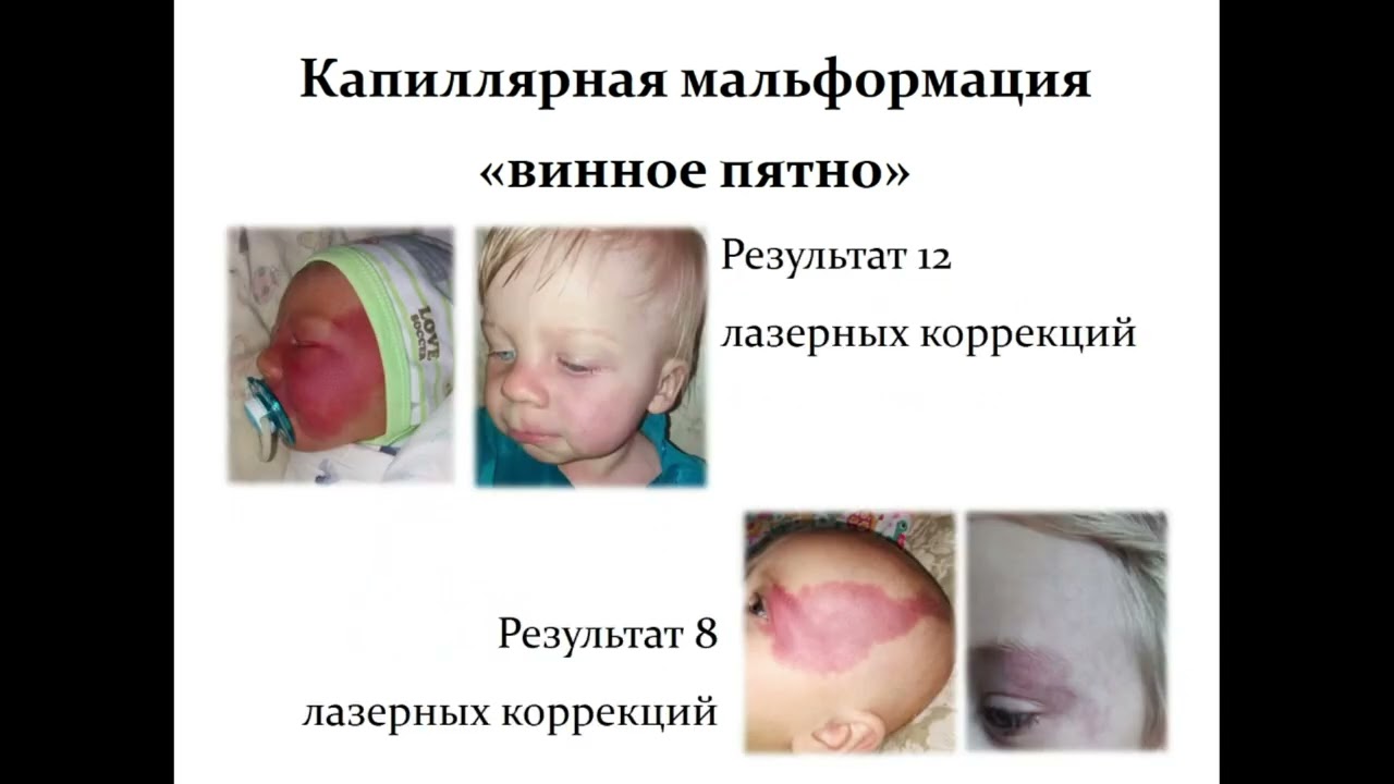 Сафин Д А Современные методы диагностикии лечения сосудистых аномалийурогенитальной области у детей