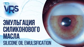 видео: Эмульгация силиконогового масла и АГО | Silicone oil emulsification and glaucoma surgery картинка: Эмульгация силиконогового масла и АГО | Silicone oil emulsification and glaucoma surgery