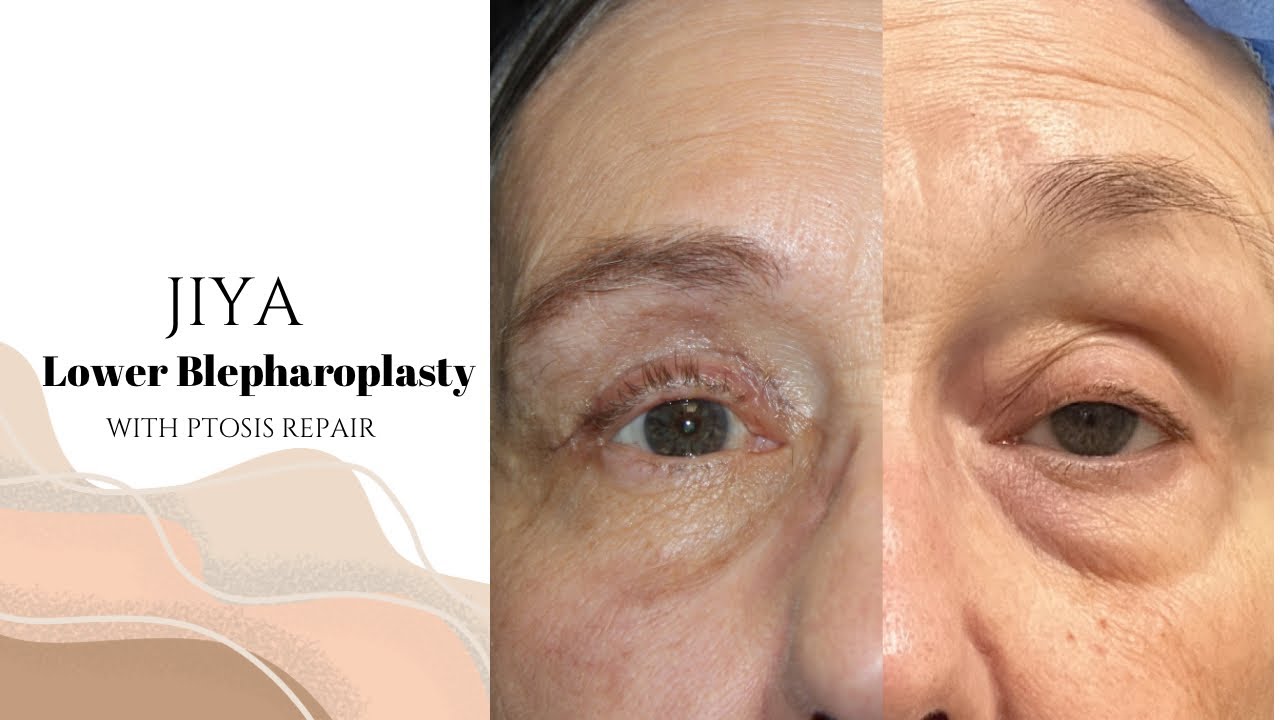 JIYA | Lower Bleph with Ptosis repair (couple weeks post-op)