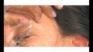 complete guide botox