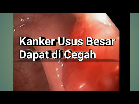 pencegahan Kanker Usus Besar dengan kolonoskopi (part I)