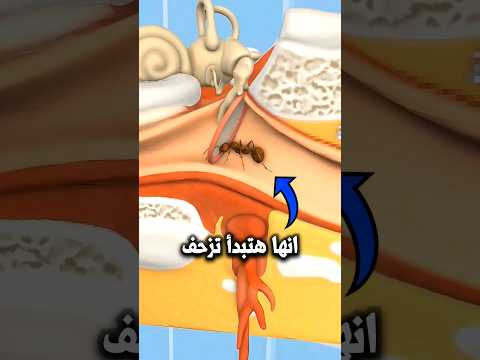 لو دخلت حشرة الأذن 