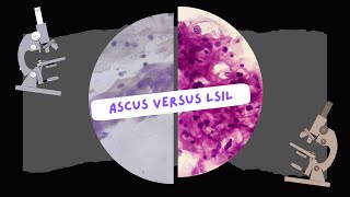 ASCUS VS LSIL. LESIONES DE BAJO GRADOI EN CUELLO UTERINO Y ATIPIAS INESPECIFICAS.