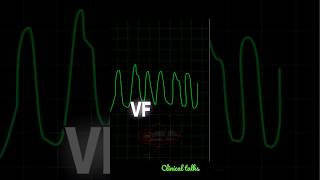 Cardiac arrhythmia || VT || VF || SVT || DC || asystole #nursing #shortvideo #clinicaltalks