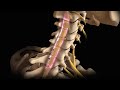 Neck Surgery | Cervical Laminectomy | Nucleus Health