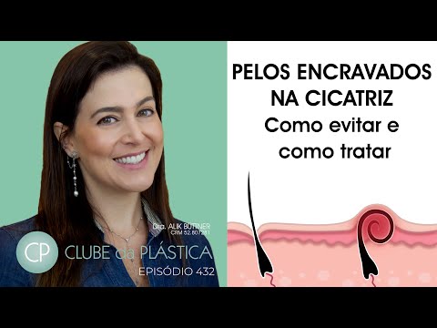 Vídeo: 3 maneiras de se livrar das cicatrizes de pêlos encravados