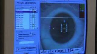 LADARVision® CustomCornea® - Bakersfield LASIK