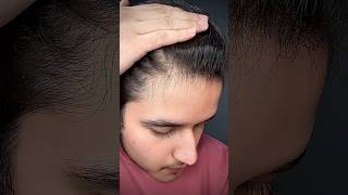 Receding Hairline Solution