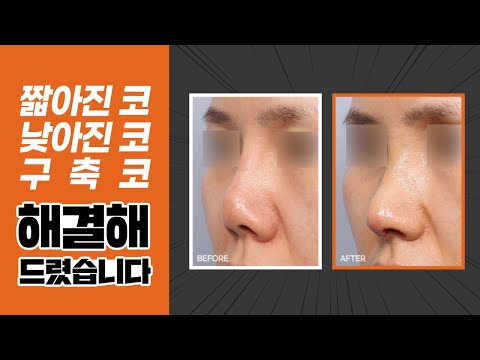 #코재수술후기 얼마나 달라졌을까? #코재수술성형외과 고르는 꿀팁!