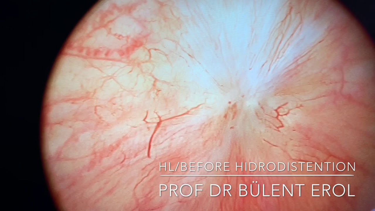 moxifloxacin chronic bacterial prostatitis