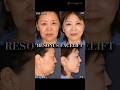 50代「腫れレベルMAX切開リフト」術後３ヶ月目インタビュー#shorts
