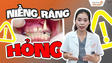 4 Dấu Hiệu Cho Thấy Niềng Răng Hỏng: Đặc Biệt Lưu Ý 80% Bệnh Nhân Chủ Quan Với Dấu Hiệu Thứ 4