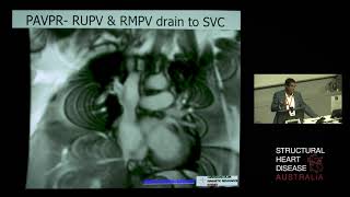 Interesting MRI Cases of the Right Heart - Dr Raj Puranik