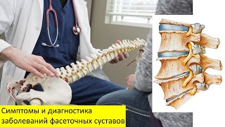 Симптомы и диагностика заболеваний фасеточных суставов