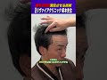 植毛2回目で薄毛はどこまで埋まる！？