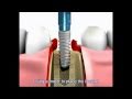 Dental implant procedure